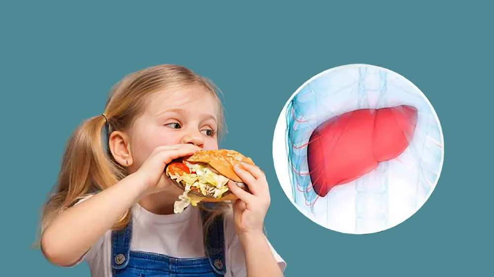 کبد چرب در کودکان