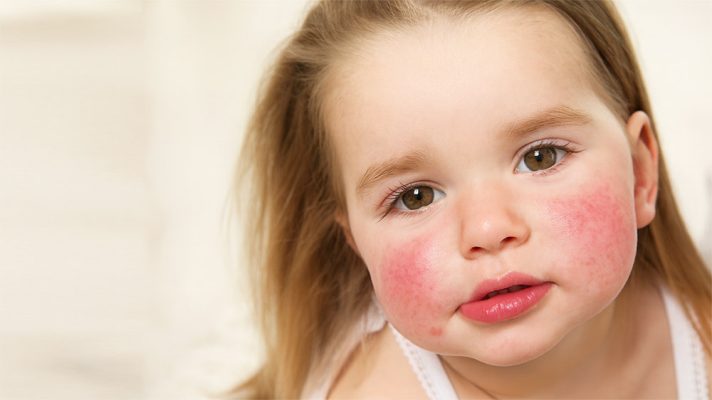 آلرژی غذایی در کودکان